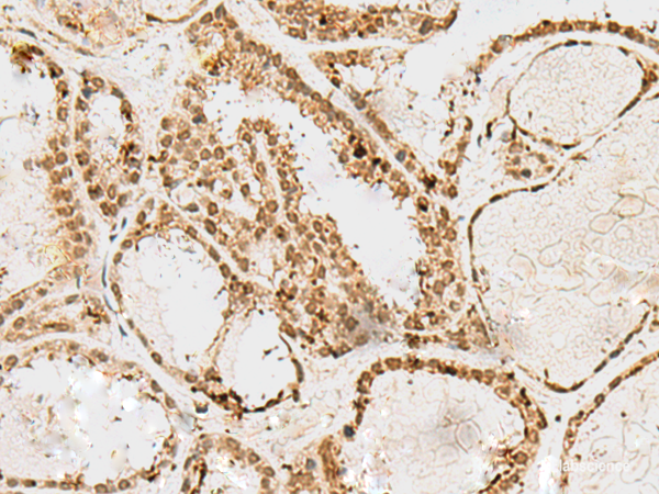 Immunohistochemistry of paraffin-embedded Human thyroid cancer tissue  using SNAPC1 Polyclonal Antibody at dilution of 1:60(×200)