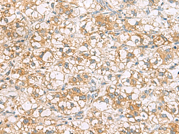 Immunohistochemistry of paraffin-embedded Human liver cancer tissue  using TLE6 Polyclonal Antibody at dilution of 1:75(×200)