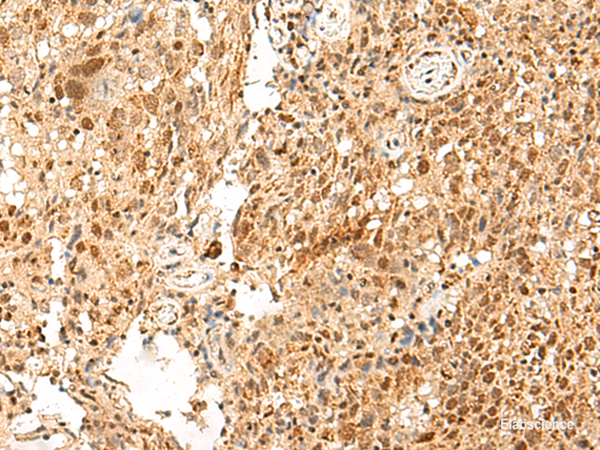 Immunohistochemistry of paraffin-embedded Human cervical cancer tissue  using PAF1 Polyclonal Antibody at dilution of 1:55(×200)