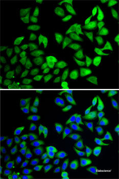 Immunohistochemistry of paraffin-embedded Human liver cancer using CDC16 Polyclonal Antibody at dilution of  1:100 (40x lens).