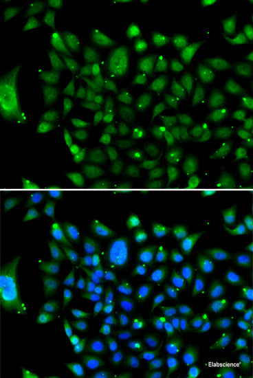 Immunohistochemistry of paraffin-embedded Human liver cancer using SYNCRIP Polyclonal Antibody at dilution of  1:100 (40x lens).