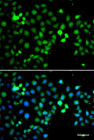 Immunohistochemistry of paraffin-embedded Human liver cancer using BLVRB Polyclonal Antibody at dilution of  1:100 (40x lens).