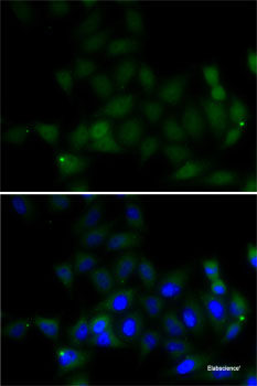Immunohistochemistry of paraffin-embedded Human liver cancer using PON1 Polyclonal Antibody at dilution of  1:100 (40x lens).