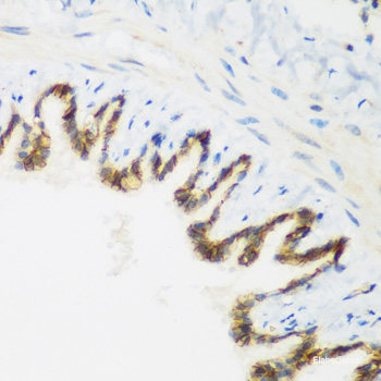 Immunohistochemistry of paraffin-embedded Human lung cancer using ATG7 Polyclonal Antibody at dilution of  1:100 (40x lens).