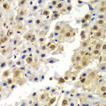 Immunohistochemistry of paraffin-embedded Human liver cancer using NAA60 Polyclonal Antibody at dilution of  1:200 (40x lens).