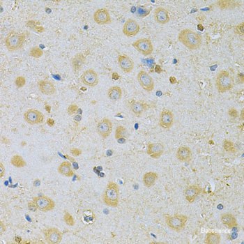 Immunohistochemistry of paraffin-embedded Human lung cancer using SH3GLB2 Polyclonal Antibody at dilution of  1:200 (40x lens).