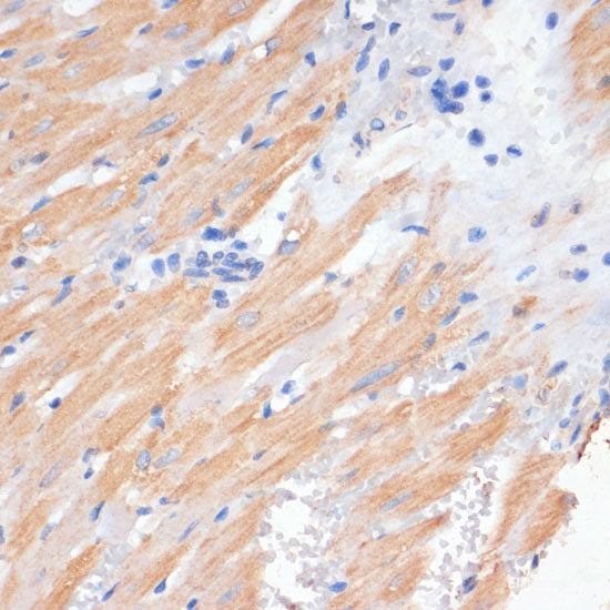 Immunohistochemistry of paraffin-embedded Human liver cancer using GLUD1 Polyclonal Antibody at dilution of  1:100 (40x lens).