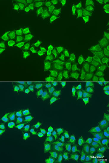 Immunohistochemistry of paraffin-embedded Human kidney cancer using VANGL2 Polyclonal Antibody at dilution of  1:100 (40x lens).