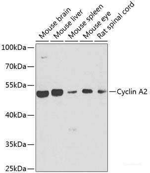 Immunohistochemistry of paraffin-embedded Human gastric cancer using ECSIT Polyclonal Antibody at dilution of  1:100 (40x lens).