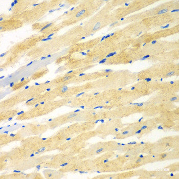 Immunohistochemistry of paraffin-embedded Human brain cancer using PIK3R3 Polyclonal Antibody at dilution of  1:100 (40x lens).