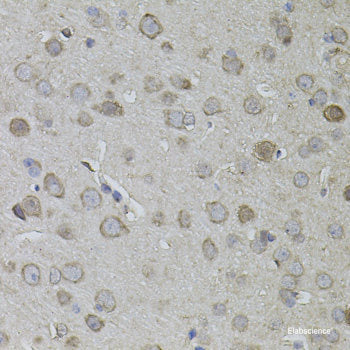 Immunohistochemistry of paraffin-embedded Human breast cancer using HDAC4 Polyclonal Antibody at dilution of  1:100 (40x lens).