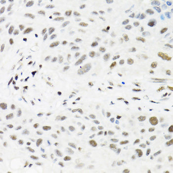 Immunohistochemistry of paraffin-embedded Human colon carcinoma using CEBPG Polyclonal Antibody at dilution of  1:100 (40x lens).