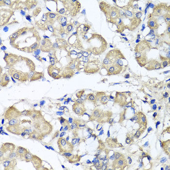 Immunohistochemistry of paraffin-embedded Human liver damage using AARS2 Polyclonal Antibody at dilution of  1:100 (40x lens).