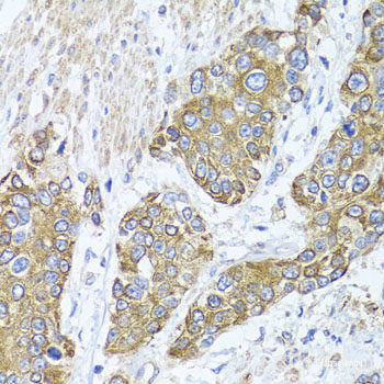 Immunohistochemistry of paraffin-embedded Human brain cancer using WIPI1 Polyclonal Antibody at dilution of  1:100 (40x lens).