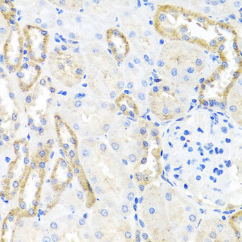 Immunohistochemistry of paraffin-embedded Human brain cancer using OCT4 Polyclonal Antibody at dilution of  1:100 (40x lens).
