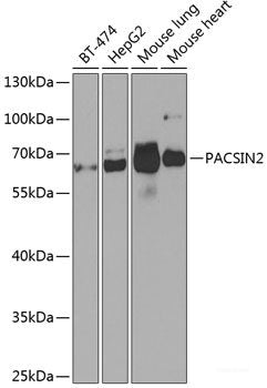 Immunohistochemistry of paraffin-embedded Human mammary cancer using SOCS5 Polyclonal Antibody at dilution of  1:100 (40x lens).