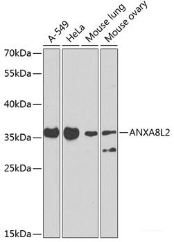 Immunohistochemistry of paraffin-embedded Human brain cancer using PAK6 Polyclonal Antibody at dilution of  1:100 (40x lens).