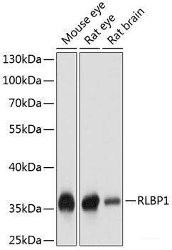 Immunohistochemistry of paraffin-embedded Human liver damage using AQP5 Polyclonal Antibody