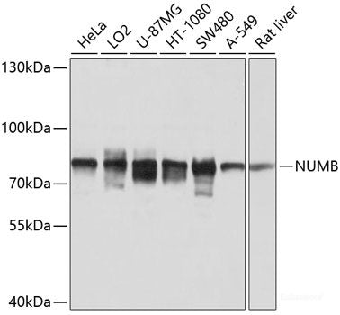 Immunohistochemistry of paraffin-embedded Human liver cancer using RRAGD Polyclonal Antibody at dilution of  1:100 (40x lens).