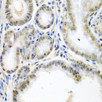 Immunohistochemistry of paraffin-embedded Human liver damage using CARD11 Polyclonal Antibody at dilution of  1:100 (40x lens).