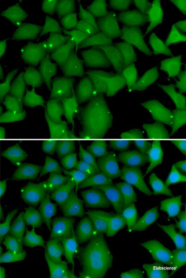 Immunohistochemistry of paraffin-embedded Human prostate cancer using PEX14 Polyclonal Antibody at dilution of  1:100 (40x lens).