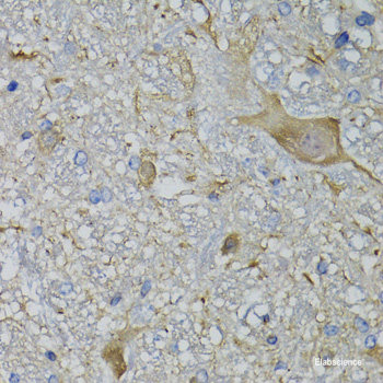 Immunohistochemistry of paraffin-embedded Human brain cancer using RUFY2 Polyclonal Antibody at dilution of  1:100 (40x lens).