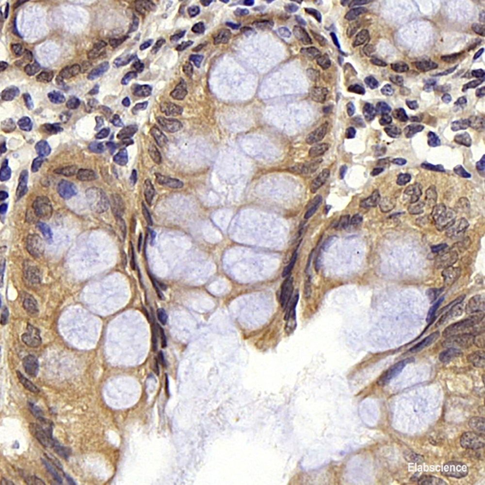 Immunohistochemistry analysis of paraffin-embedded human lung cancer   using FOXO1 Polyclonal Antibody at dilution of 1:300.