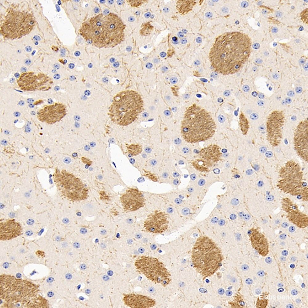 Immunohistochemistry analysis of paraffin-embedded Human lung cancer  using P38 Polyclonal Antibody at dilution of 1:500.