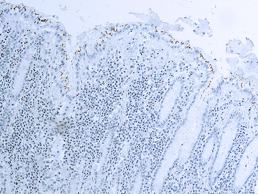 Helicobacter Pylori