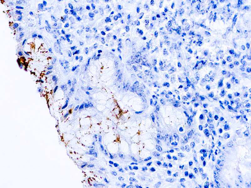 Heliocobactor pylori
