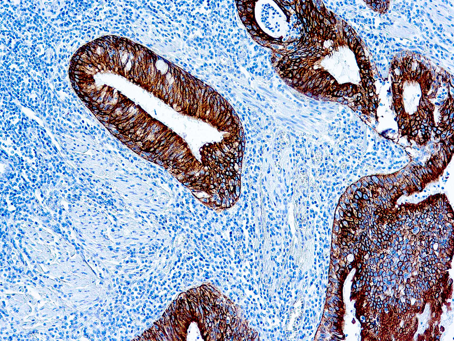 Cytokeratin AE1, Acidic