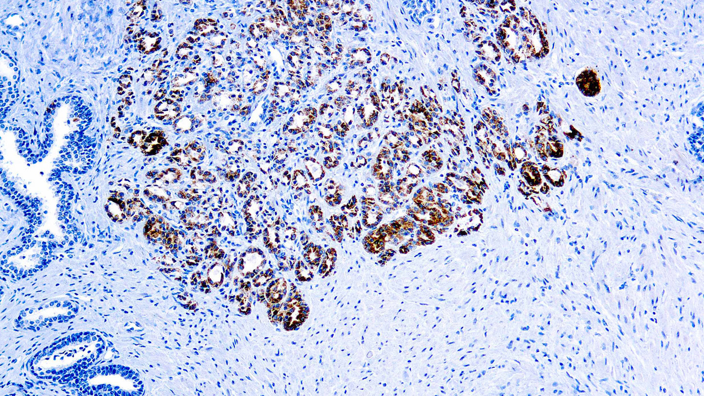 p504S/Alpha-Methylacyl-CoA Racemase (AMACR)