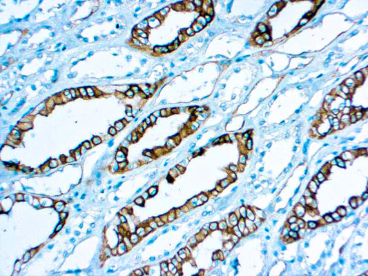 Renal Cell Carcinoma
