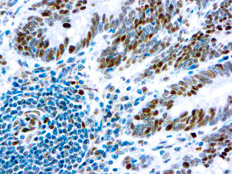 Retinoblastoma Protein