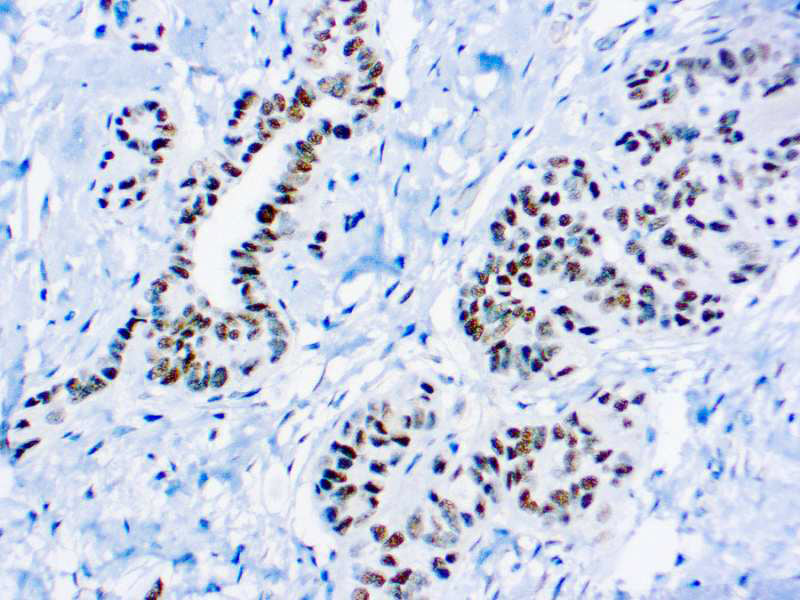 Wilms Tumor 1 Protein (WT1)